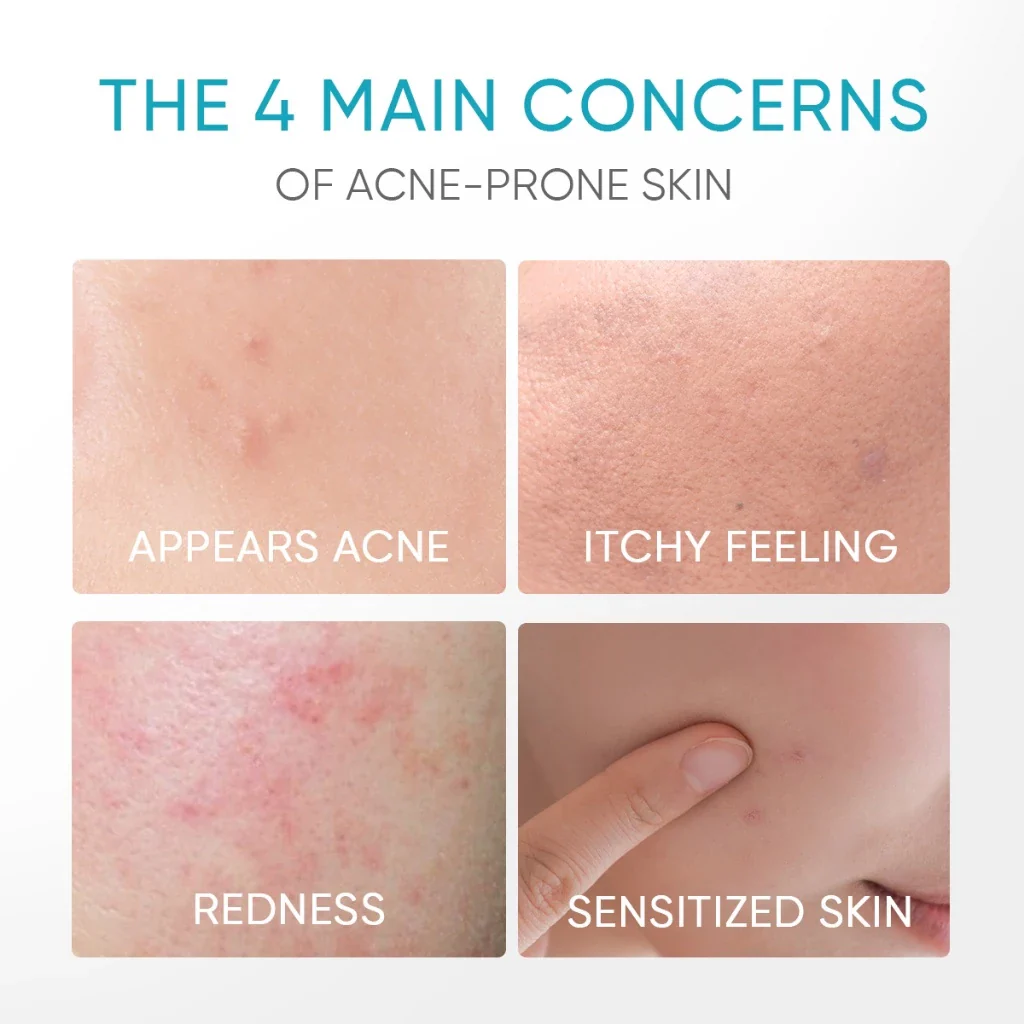 5% Panthenol Acne Calming Water Gel - Image 6